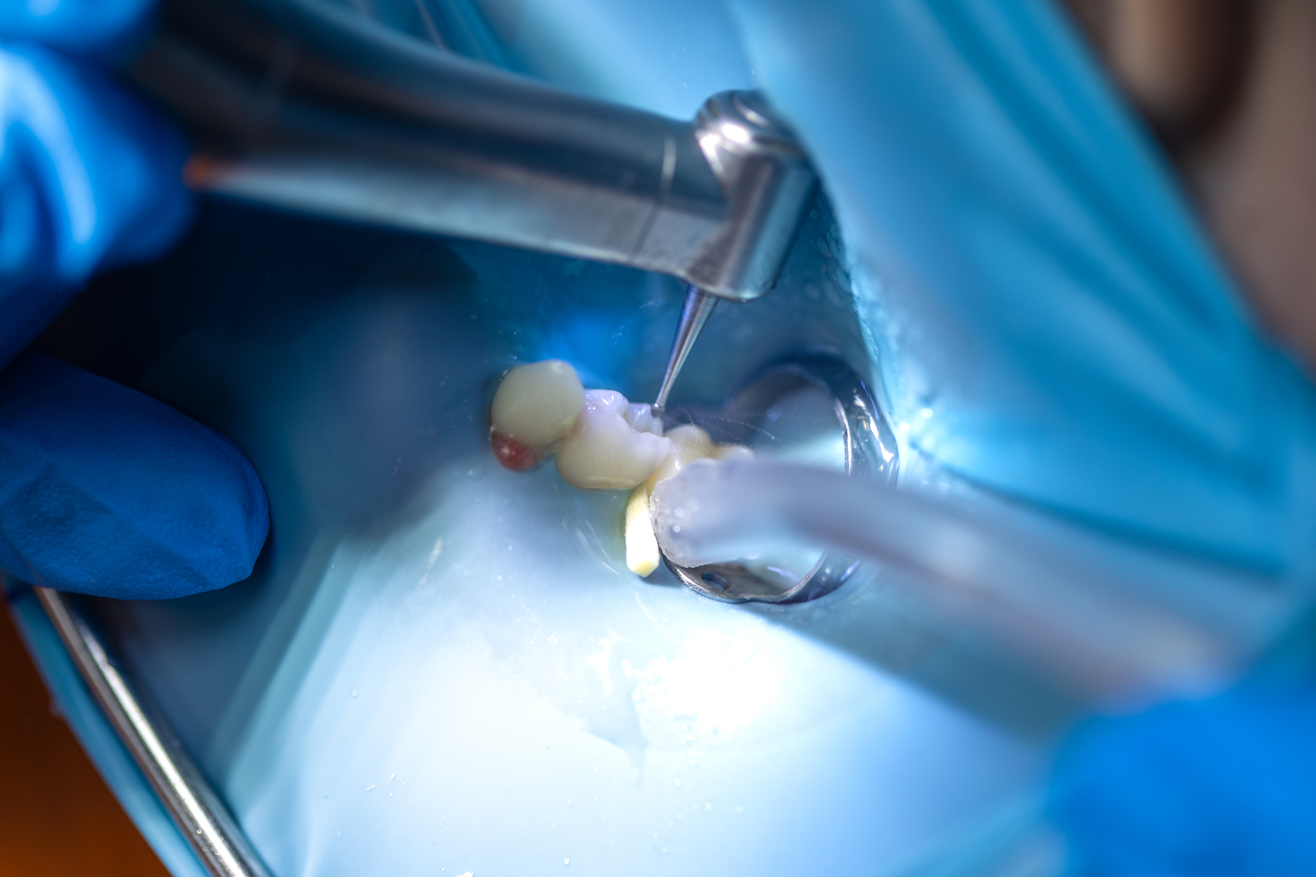 Endodoncia